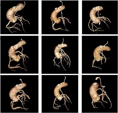 Non-invasive Ischaemia Testing in Patients With Prior Coronary Artery Bypass Graft Surgery: Technical Challenges, Limitations, and Future Directions